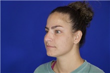 Rhinoplasty Before Photo by Thanapoom Boonipat, MD; Lubbock, TX - Case 51592