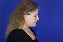 Facelift After Photo by Thanapoom Boonipat, MD; Lubbock, TX - Case 51588