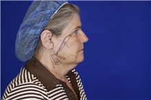 Facelift Before Photo by Thanapoom Boonipat, MD; Lubbock, TX - Case 51588