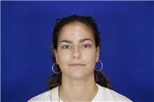 Rhinoplasty After Photo by Thanapoom Boonipat, MD; Lubbock, TX - Case 51589