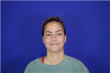 Rhinoplasty Before Photo by Thanapoom Boonipat, MD; Lubbock, TX - Case 51589