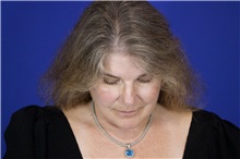 Facelift After Photo by Thanapoom Boonipat, MD; Lubbock, TX - Case 51596