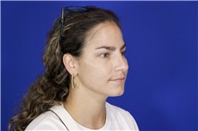 Rhinoplasty After Photo by Thanapoom Boonipat, MD; Lubbock, TX - Case 51595