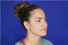 Rhinoplasty Before Photo by Thanapoom Boonipat, MD; Lubbock, TX - Case 51595