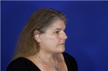 Facelift After Photo by Thanapoom Boonipat, MD; Lubbock, TX - Case 51593