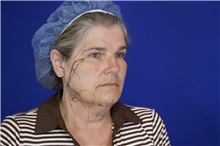 Facelift Before Photo by Thanapoom Boonipat, MD; Lubbock, TX - Case 51593