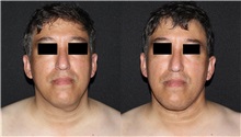 Liposuction Before Photo by Libby Copeland-Halperin, MD; New York, NY - Case 49692 Liposuction Before Photo by Libby Copeland-Halperin, MD; New York, NY - Case 49692