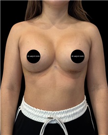 Breast Augmentation After Photo by Fethi Sarper Mete, MD; ,  - Case 50280