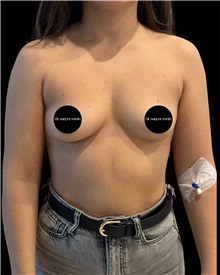 Breast Augmentation Before Photo by Fethi Sarper Mete, MD; ,  - Case 50280