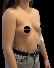 Breast Augmentation Before Photo by Fethi Sarper Mete, MD; ,  - Case 50280