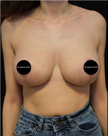 Breast Reduction After Photo by Fethi Sarper Mete, MD; ,  - Case 50308