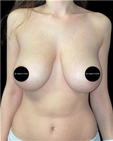 Breast Reduction Before Photo by Fethi Sarper Mete, MD; ,  - Case 50308