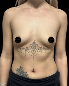 Breast Augmentation Before Photo by Fethi Sarper Mete, MD; ,  - Case 50302