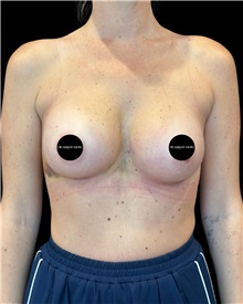 Breast Augmentation After Photo by Fethi Sarper Mete, MD; ,  - Case 50309