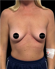 Breast Augmentation Before Photo by Fethi Sarper Mete, MD; ,  - Case 50309