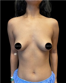 Breast Augmentation Before Photo by Fethi Sarper Mete, MD; ,  - Case 50306
