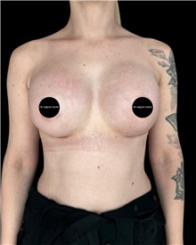 Breast Augmentation After Photo by Fethi Sarper Mete, MD; ,  - Case 50311