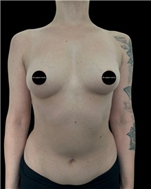 Breast Augmentation Before Photo by Fethi Sarper Mete, MD; ,  - Case 50311