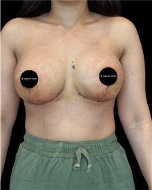 Breast Lift After Photo by Fethi Sarper Mete, MD; ,  - Case 50303