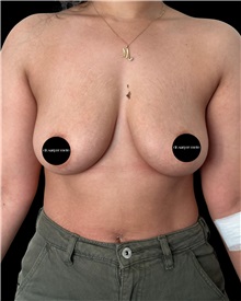 Breast Lift Before Photo by Fethi Sarper Mete, MD; ,  - Case 50303