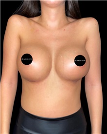 Breast Augmentation After Photo by Fethi Sarper Mete, MD; ,  - Case 50304