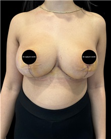 Breast Reduction After Photo by Fethi Sarper Mete, MD; ,  - Case 50305