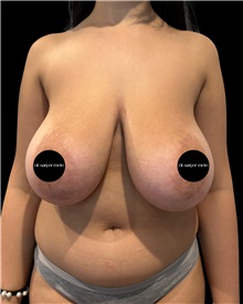 Breast Reduction Before Photo by Fethi Sarper Mete, MD; ,  - Case 50305