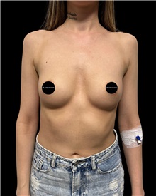 Breast Augmentation Before Photo by Fethi Sarper Mete, MD; ,  - Case 50310