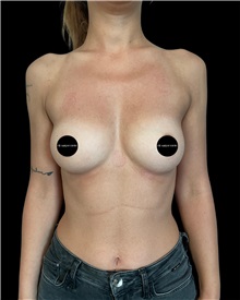 Breast Augmentation Before Photo by Fethi Sarper Mete, MD; ,  - Case 50307