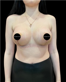 Breast Lift After Photo by Fethi Sarper Mete, MD; ,  - Case 50312