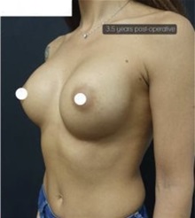 Breast Augmentation After Photo by Ozge Ergun, MD; Istanbul, C - Case 49754 Breast Augmentation After Photo by Ozge Ergun, MD; Istanbul, C - Case 49754