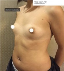 Breast Augmentation Before Photo by Ozge Ergun, MD; Istanbul, C - Case 49754 Breast Augmentation Before Photo by Ozge Ergun, MD; Istanbul, C - Case 49754