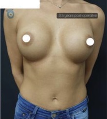 Breast Augmentation After Photo by Ozge Ergun, MD; Istanbul, C - Case 49754