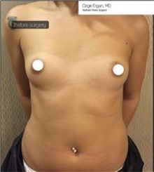 Breast Augmentation Before Photo by Ozge Ergun, MD; Istanbul, C - Case 49754