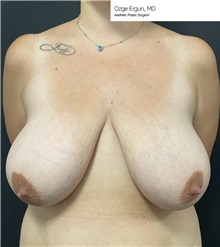 Breast Reduction Before Photo by Ozge Ergun, MD; Istanbul, C - Case 49755 Breast Reduction Before Photo by Ozge Ergun, MD; Istanbul, C - Case 49755