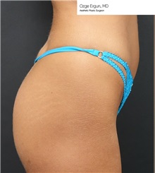 Buttock Implants Before Photo by Ozge Ergun, MD; Istanbul, C - Case 49758