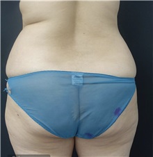 Tummy Tuck Before Photo by Ozge Ergun, MD; Istanbul, C - Case 49766