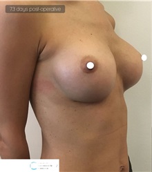 Breast Augmentation After Photo by Ozge Ergun, MD; Istanbul, C - Case 49768 Breast Augmentation After Photo by Ozge Ergun, MD; Istanbul, C - Case 49768