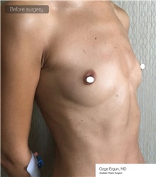 Breast Augmentation Before Photo by Ozge Ergun, MD; Istanbul, C - Case 49768 Breast Augmentation Before Photo by Ozge Ergun, MD; Istanbul, C - Case 49768