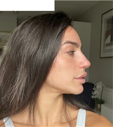 Chin Augmentation After Photo by Ozge Ergun, MD; Istanbul, C - Case 49770