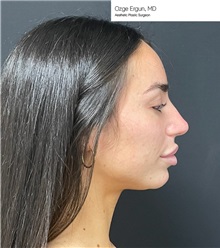 Chin Augmentation Before Photo by Ozge Ergun, MD; Istanbul, C - Case 49770