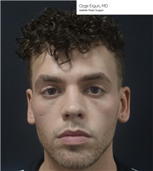 Facial Implants Before Photo by Ozge Ergun, MD; Istanbul, C - Case 49769