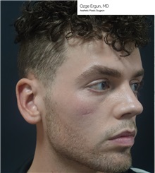 Facial Implants Before Photo by Ozge Ergun, MD; Istanbul, C - Case 49769