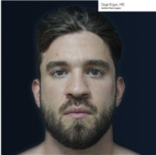 Facial Implants Before Photo by Ozge Ergun, MD; Istanbul, C - Case 49802
