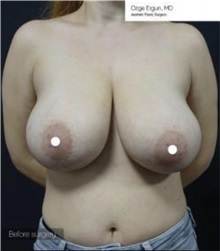 Breast Reduction Before Photo by Ozge Ergun, MD; Istanbul, C - Case 49784 Breast Reduction Before Photo by Ozge Ergun, MD; Istanbul, C - Case 49784