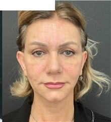 Facelift After Photo by Ozge Ergun, MD; Istanbul, C - Case 49808