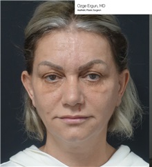 Facelift Before Photo by Ozge Ergun, MD; Istanbul, C - Case 49808