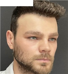 Chin Augmentation After Photo by Ozge Ergun, MD; Istanbul, C - Case 49797