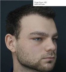 Chin Augmentation Before Photo by Ozge Ergun, MD; Istanbul, C - Case 49797