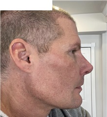 Facial Implants After Photo by Ozge Ergun, MD; Istanbul, C - Case 49803